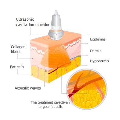 Does Ultrasonic Cavitation Really Work? Review & Before/After ...