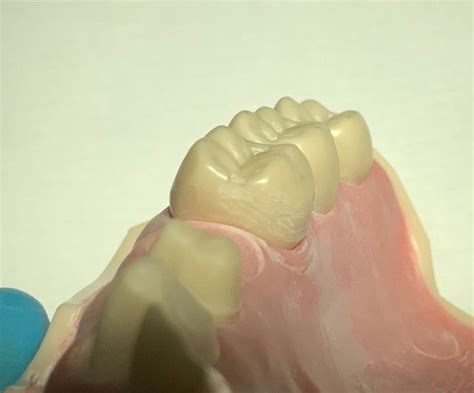 Resin Bonded Cantilever Bridge Posterior Toothpreps