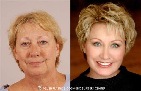 Dermabrasion Before And After English Plastic And Cosmetic Surgery