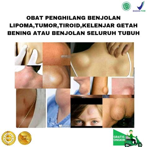 Jual Chitin Chitosan Obat Benjolan Di Tangan Benjolan Di Leher