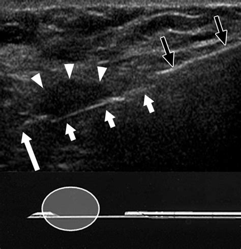 Us Guided Core Needle Biopsy Of Axillary Lymph Nodes In Patients With Breast Cancer Why And How