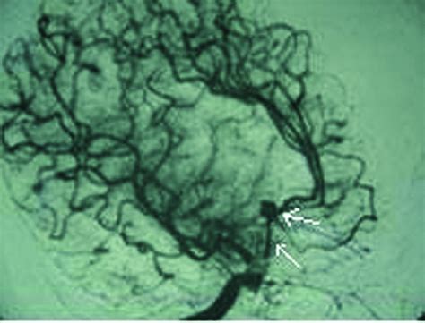 A Lateral View From Right Carotid Artery Angiography Showing An Acoma Download Scientific