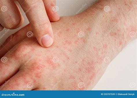 Hands With Allergy Reaction From Taking Medicines By Effect