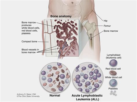 What Is Leukemia Leukemia Images And Photos Finder