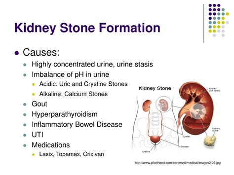 Ppt Kidney Stones Powerpoint Presentation Id23768