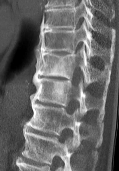 Diffuse Idiopathic Skeletal Hyperostosis Physiopedia