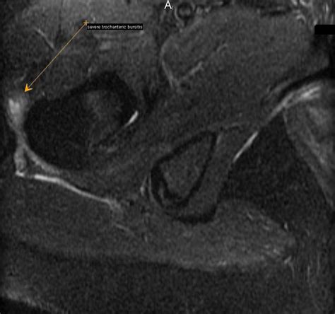 Asymmetric Piriformis Muscles Neurography Institute