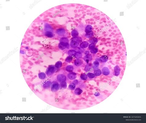 Photomicrograph Fine Needle Aspiration Fna Cytology Stock Photo