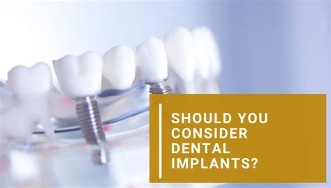 Should You Consider Dental Implants Debunking The Myths