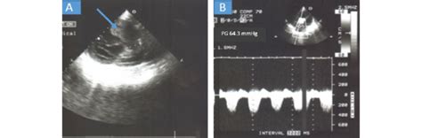 A Two Dimensional Transthoracic Echocardiogram TTE Parasternal