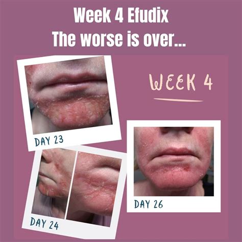 Best Efudix For Sun Spots Treatment In Brisbane Dr Davin Lim