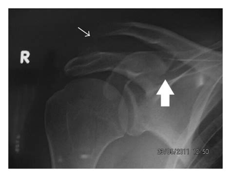 Acromioclavicular Dislocation Associated With Coracoid Process Fracture Report Of Two Cases And