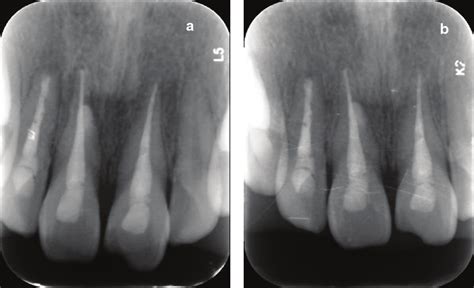 A A 6 Month Follow Up Radiograph Showed The Healed Lesions Of Teeth