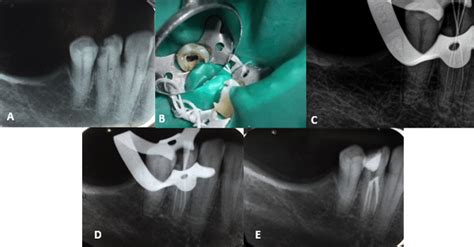 Mandibular Right First Premolar 44 A Preoperative Radiograph B