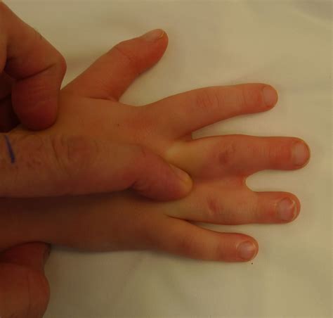 Partial Syndactyly Congenital Hand And Arm Differences Washington