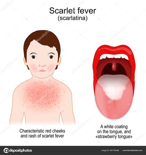 Scarlet Fever Signs Symptoms Scarlatina Child Rash Characteristic Red