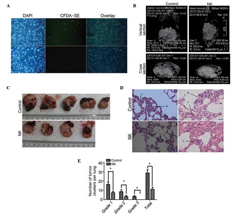 Natural Killer Cells Inhibit Pulmonary Metastasis Of Hepatocellular