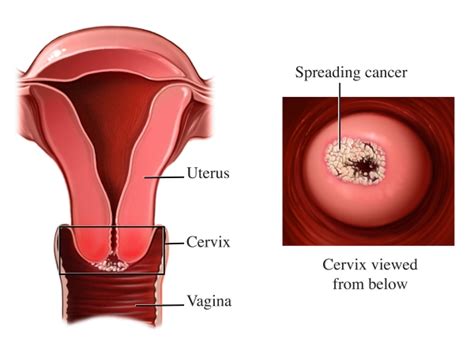 Github Kapeep Cervical Cancer Prediction