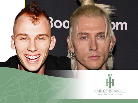 Machine Gun Kelly Mgk Hair Transplant The Story Behind It