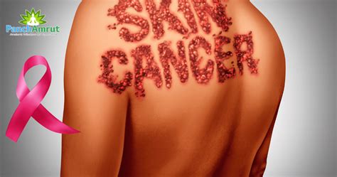 Skin Cancer Ayurvedic Treatment Panchamrut Ayurveda Cancer Treatment
