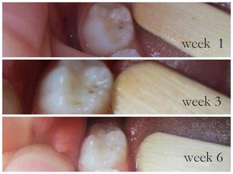 More Photographic Proof Cavities Heal | The Healthy Home Economist