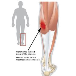 Pulled or Strained Calf Muscle