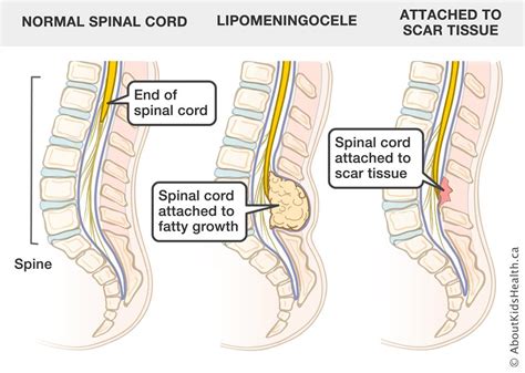 What is Tethered Cord Syndrome? - RTHM