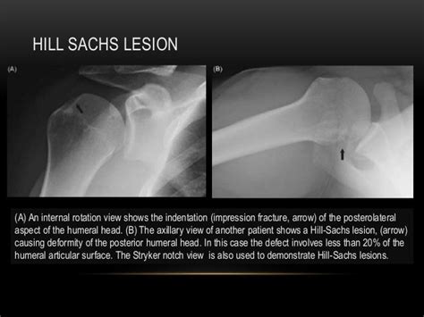 Radiographic Evaluation Of Shoulder