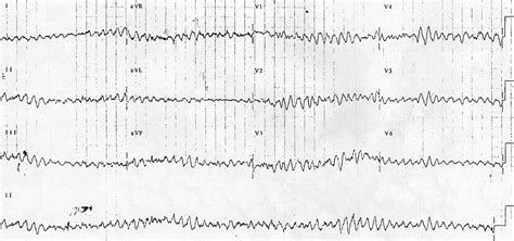 Ventricular Fibrillation Vf • Litfl • Ecg Library Diagnosis