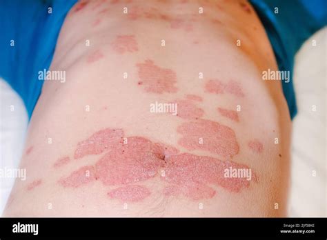 Large Red Inflamed Scaly Rash On The Stomach Acute Psoriasis On The