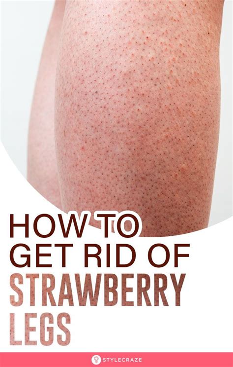 Natural Ways To Get Rid Of Strawberry Legs Strawberry Legs