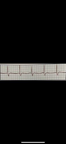 Ekg Strips Flashcards Quizlet