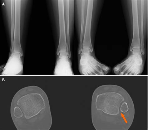 Acute Syndesmotic Injuries In Ankle Fractures From Diagnosis To