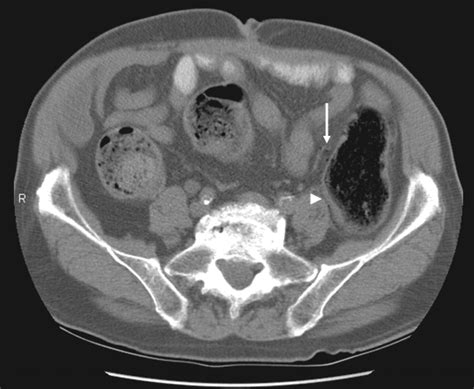 Stercoral Colitis Leading To Fatal Peritonitis Ct Findings Ajr