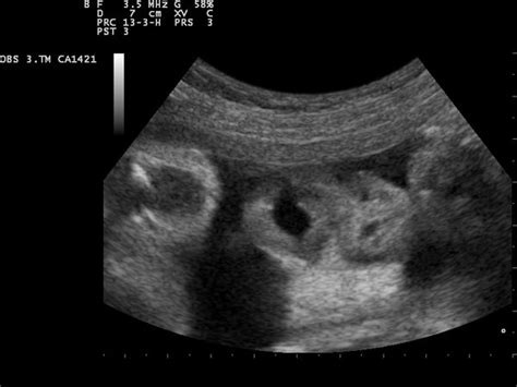 Illegal In India To Know A Baby S Sex Before Birth Snopes
