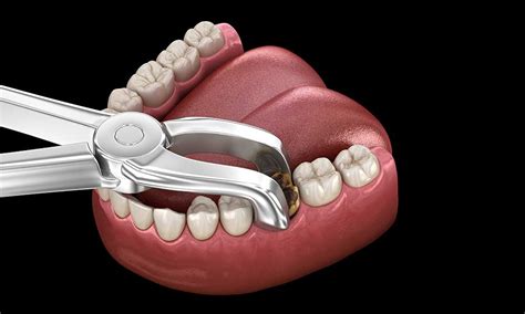 What Is Alveoloplasty Omega Dental Houston Tx