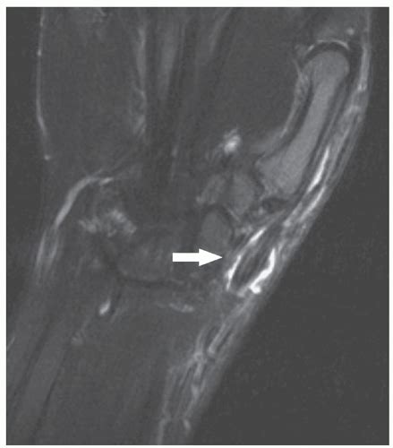 Ultrasound Guided Injection Technique For De Quervain Tenosynovitis Anesthesia Key