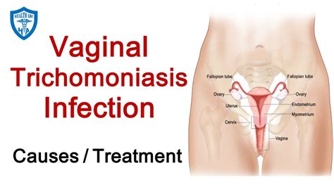 What Is Trichomoniasis Sexually Transmitted Diseases Std Symptoms