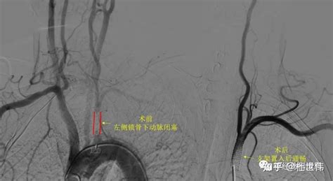 “盗血”笔记——锁骨下动脉盗血综合征 知乎