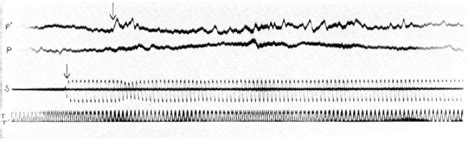 Figure 2 from LVII Latent Period of the Crossed Stapedius Reflex in Man ...