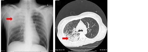 Pseudomonas Aeruginosa Community Acquired Pneumonia With Septicemia In