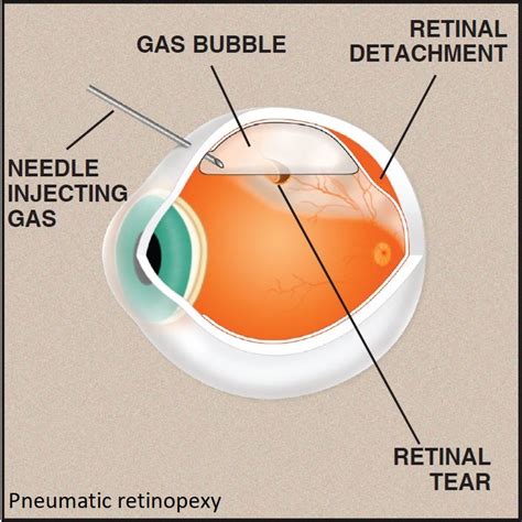 Ophthalmology Expert Witness Services