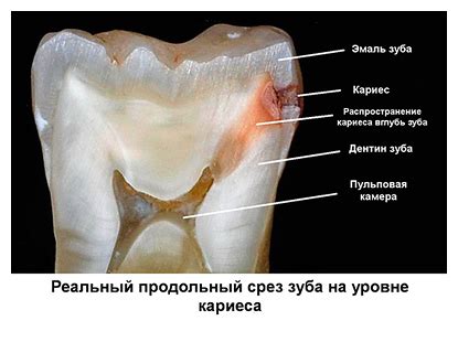 Кариес между зубами — как лечат межзубной кариес верхних и передних ...