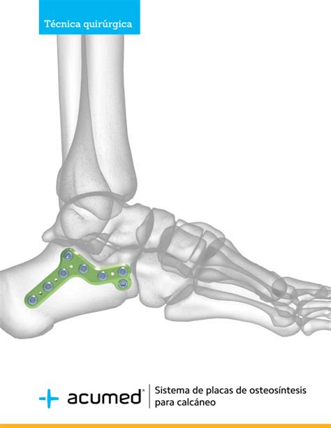 Sistema De Placas De Osteos Ntesis Para Calc Neo T Cnica Quir Rgica