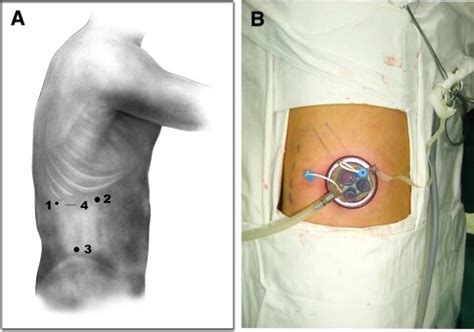 Incision And Port Sites For The Standard Procedure And The