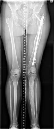 Fibrous Dysplasia Polyostotic Image Radiopaedia Org