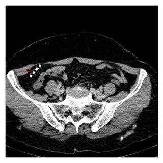 Pelvic X-ray reveals a Lippes loop IUD in the pelvis. | Download ...