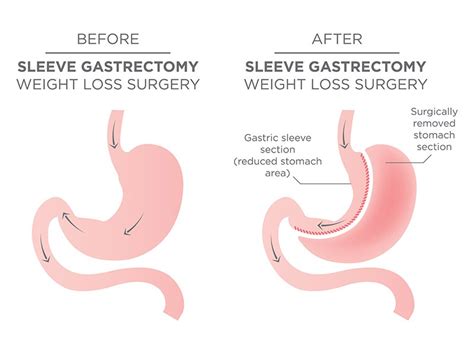 جراحة تکمیم المعدة في إيران طب طهران علاج آمن