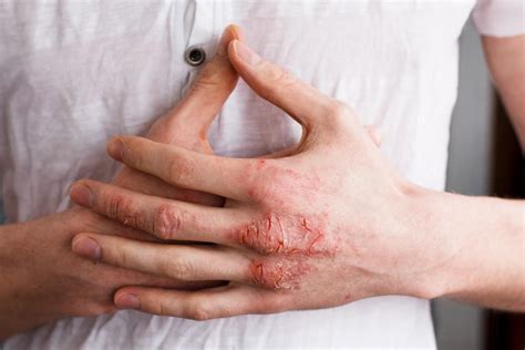 Different Types Of Eczema Specialists In Dermatology