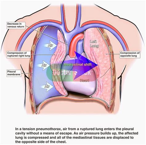 Emergency Decompression Of Tension Pneumothorax Tutorial Video